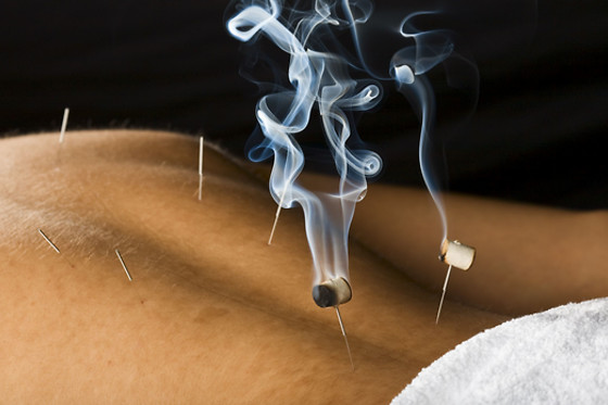 A 45-minute Full Relaxing Acupuncture + Cupping Treatment with consultation at Enjoy Acupuncture Wellness