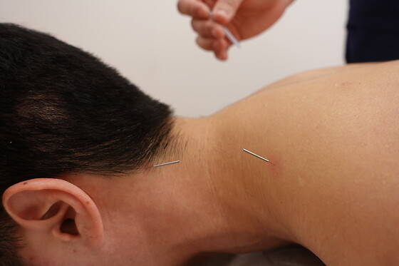Relax and Renew: An Hour of Acupuncture and Massage